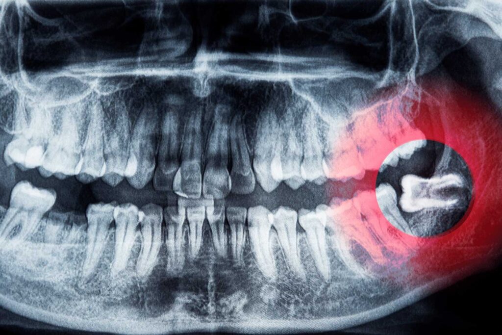Extração de siso com planejamento individualizado e tecnologia avançada na Clínica Armoni em Alphaville