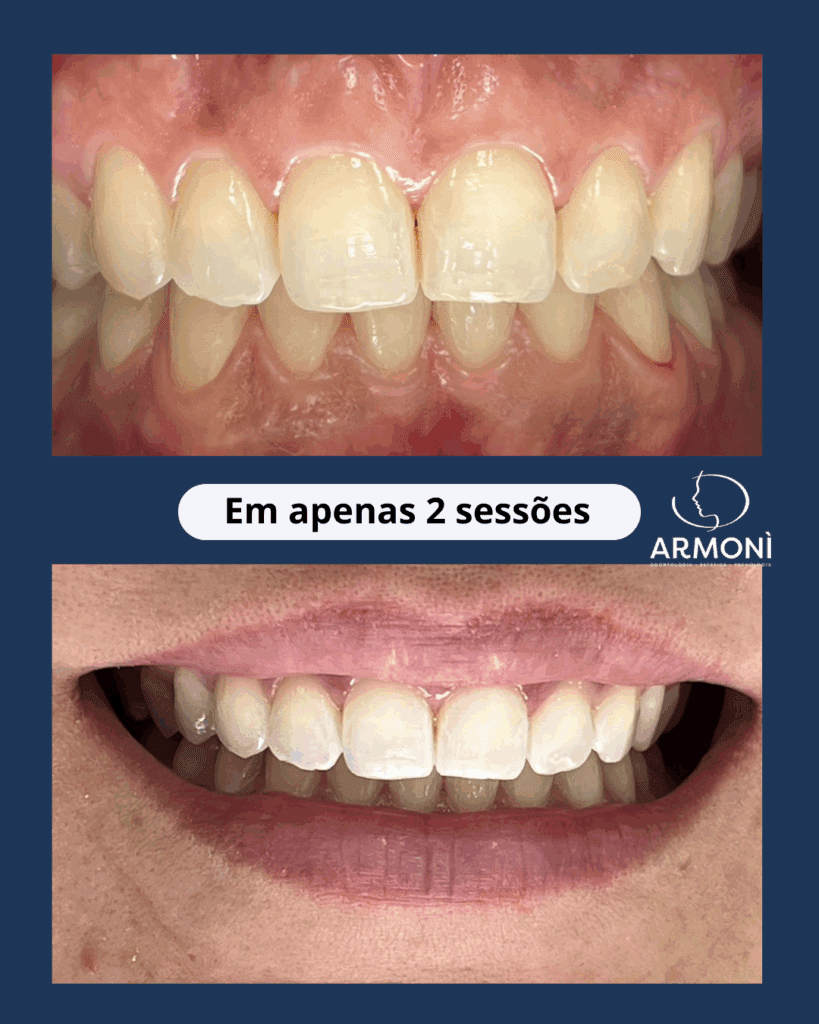 Paciente da Clínica Armoni em Alphaville com sorriso renovado após clareamento dental a laser realizado em apenas 2 sessões