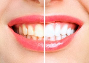 woman teeth before and after whitening. Over white background. Dental clinic patient. Image symbolizes oral care dentistry, stomatology.